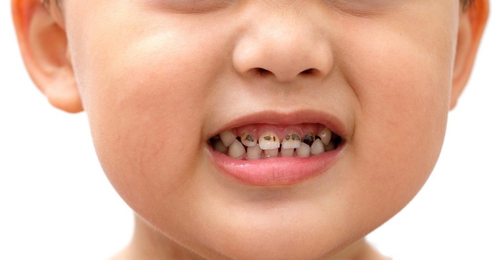 preventing tooth decay children tips parents