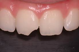Enamel Fracture Treatment in Wheat Ridge