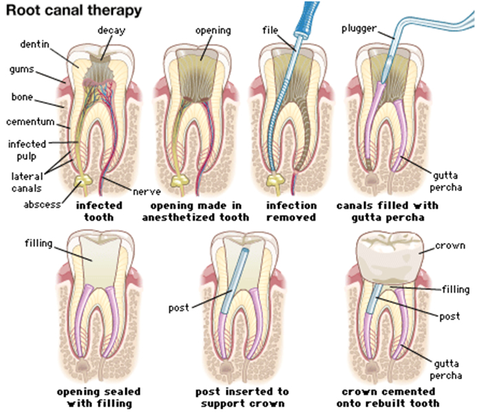 root canal treatment in adults teeth near you