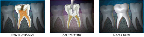 root canal treatment in babys teeth in wheat ridge