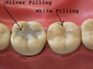 amalgam fillings for children near you