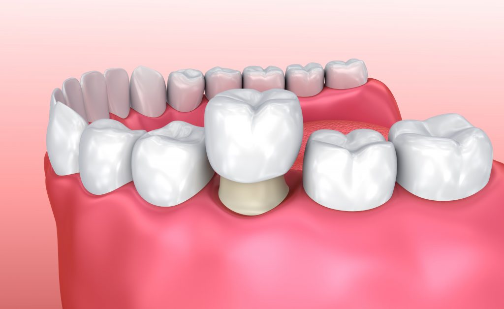 Types of Pediatric Dental Crowns