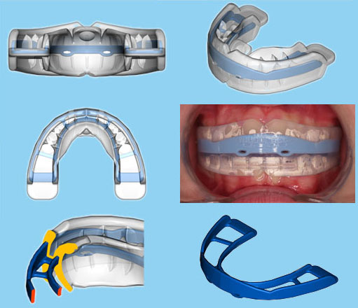 Resources of Myobrace