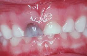 Injured Primary Incisors