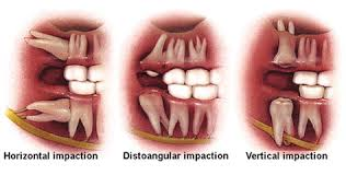 Wisdom teeth extractions in wheat ridge