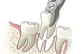 teeth extractions in wheat ridge